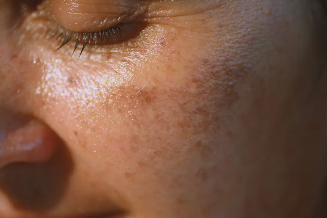 Understanding and Treating Hyperpigmentation with Haru & Bom