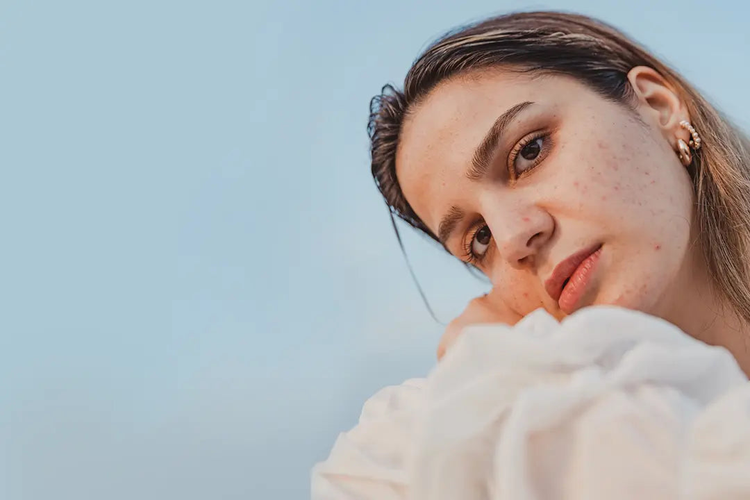 Portrait d'une jeune femme à la peau acnéique haruxbom