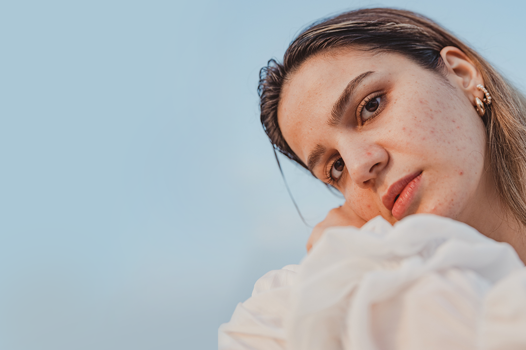 Portrait d'une jeune femme à la peau acnéique haruxbom