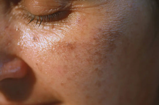 Comprendre-et-Traiter-l-Hyperpigmentation-avec-Haru-Bom Haru & Bom