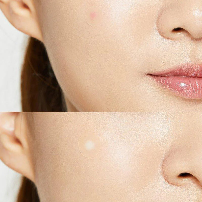 COSRX Acne Pimple Master Patch — Hydrocolloid Acne Patches